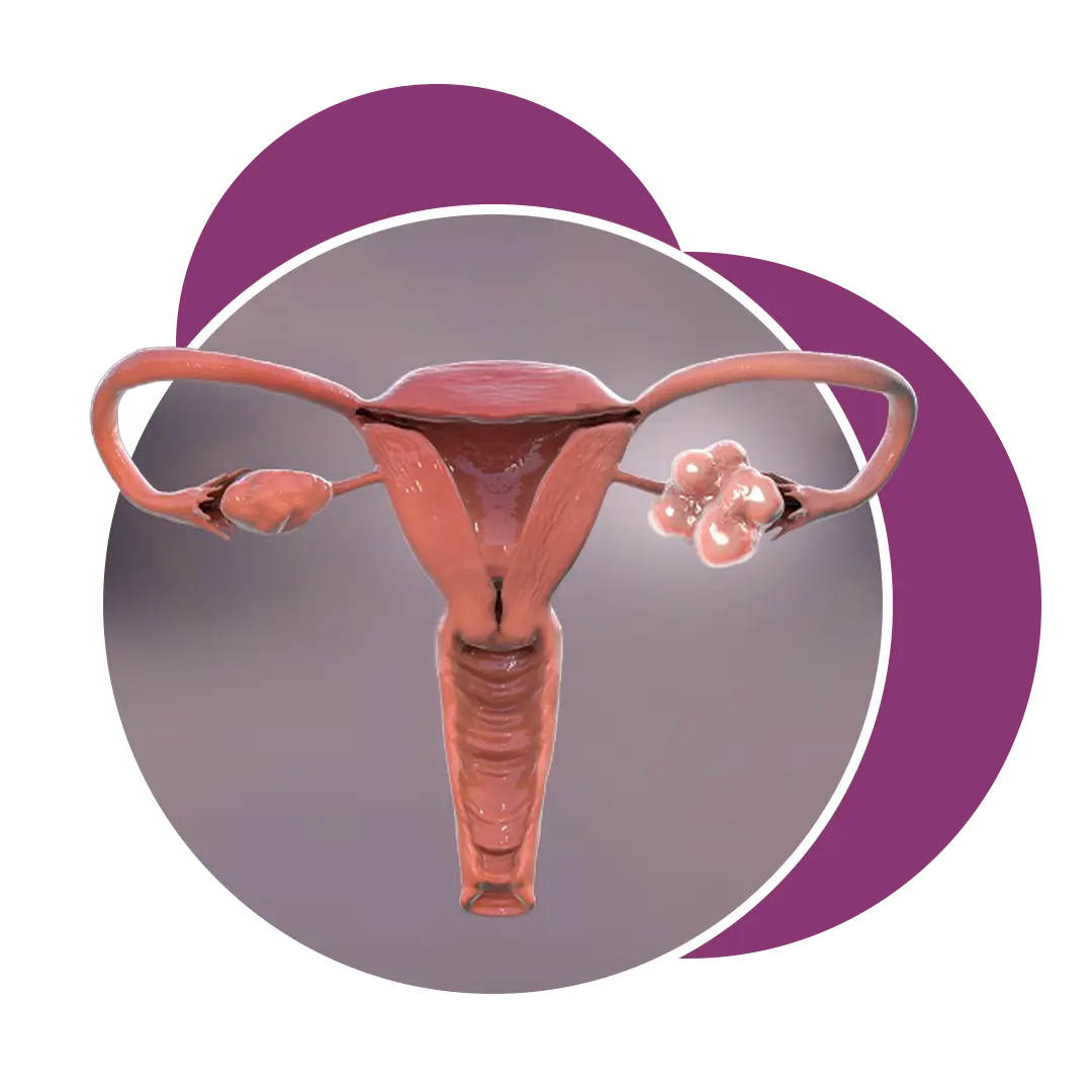 Ovulatory Dysfunction in Ahmedabad